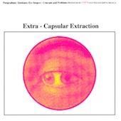 Extra-Capsular Extraction