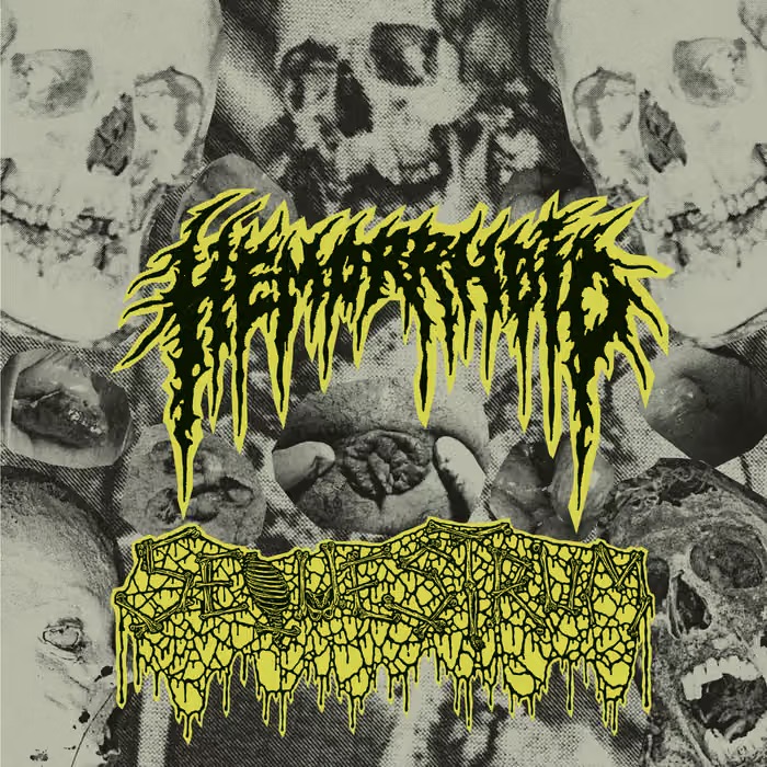 Hemorrhoid / Sequestrum